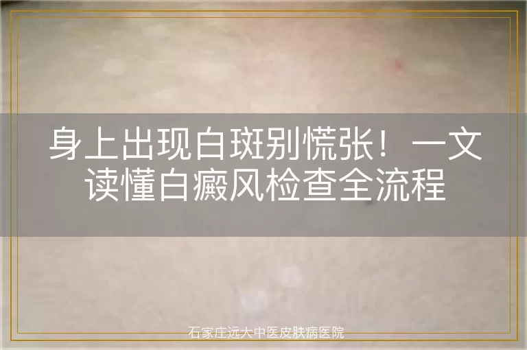 身上出现白斑别慌张!一文读懂白癜风检查全流程