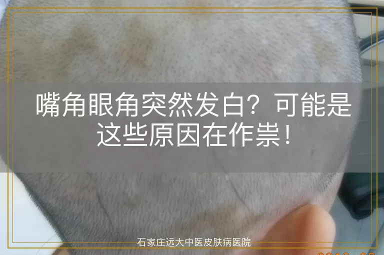 嘴角眼角突然发白？可能是这些原因在作祟！