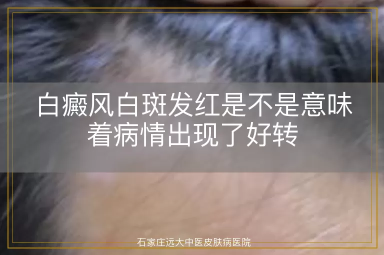 白癜风白斑发红是不是意味着病情出现了好转