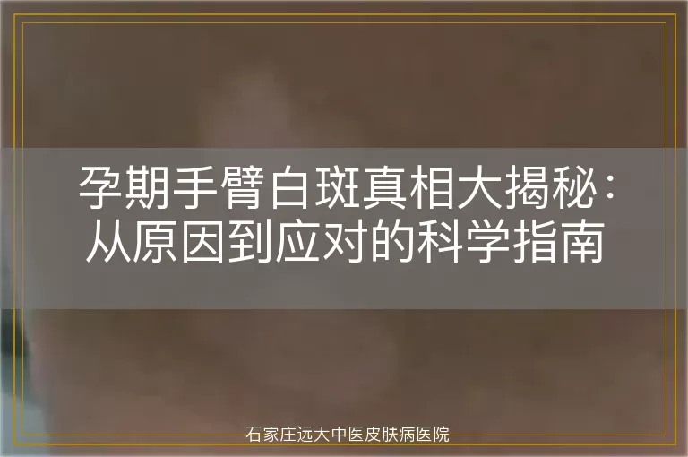 孕期手臂白斑真相大揭秘：从原因到应对的科学指南