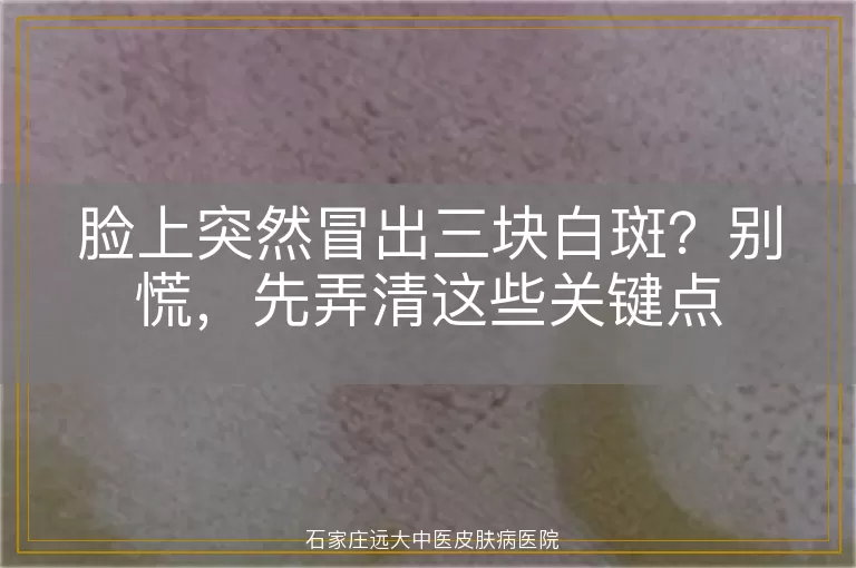 脸上突然冒出三块白斑?别慌,先弄清这些关键点