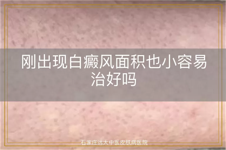 刚出现白癜风面积也小容易治好吗