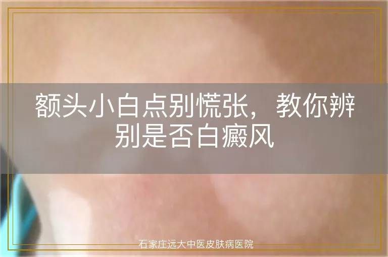 额头小白点别慌张，教你辨别是否白癜风