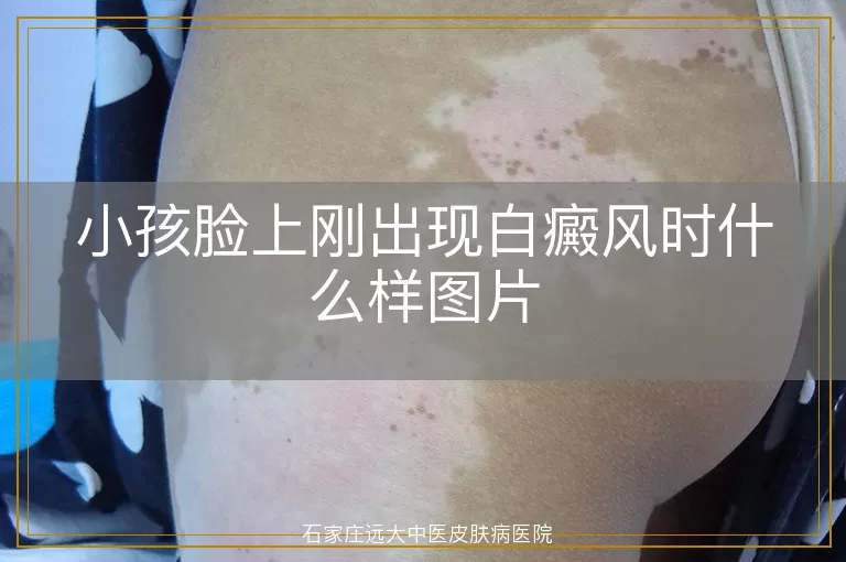 小孩脸上刚出现白癜风时什么样图片