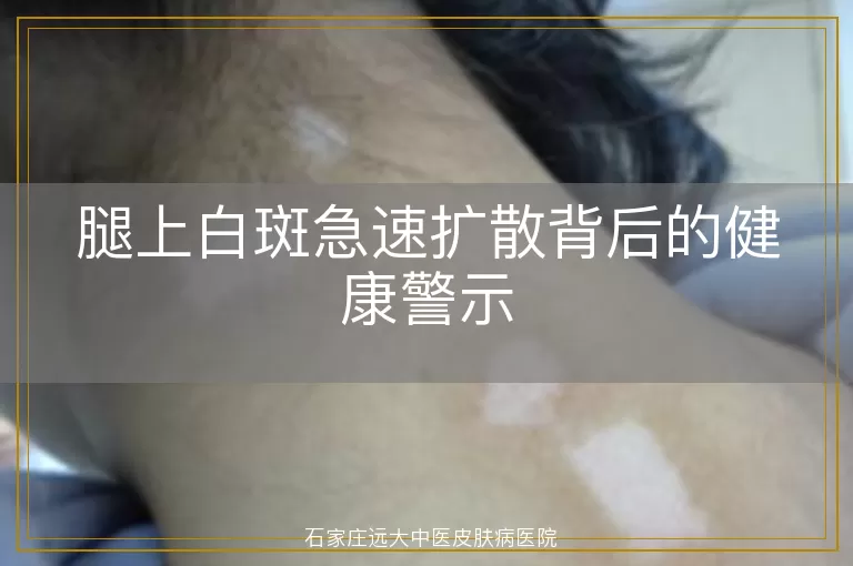 腿上白斑急速扩散背后的健康警示