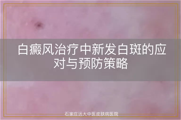 白癜风治疗中新发白斑的应对与预防策略
