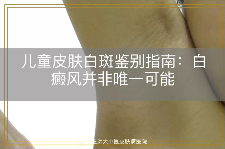 儿童皮肤白斑鉴别指南：白癜风并非唯一可能