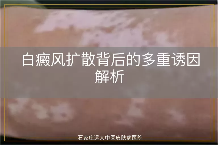 白癜风扩散背后的多重诱因解析