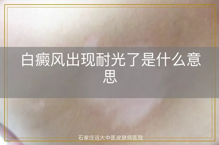 白癜风出现耐光了是什么意思