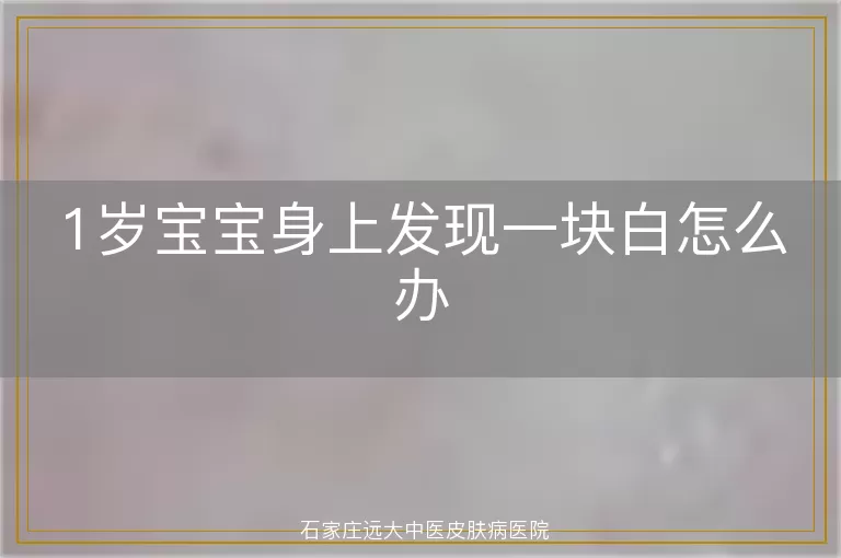 1岁宝宝身上发现一块白怎么办