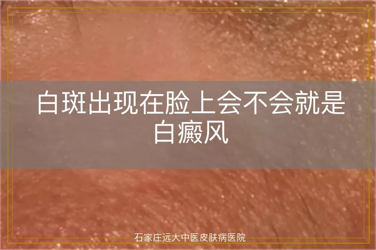 白斑出现在脸上会不会就是白癜风