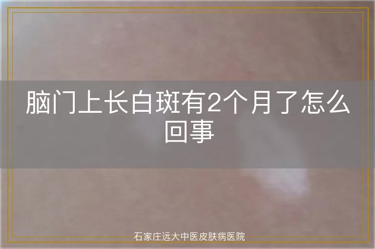 脑门上长白斑有2个月了怎么回事