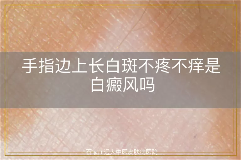 手指边上长白斑不疼不痒是白癜风吗