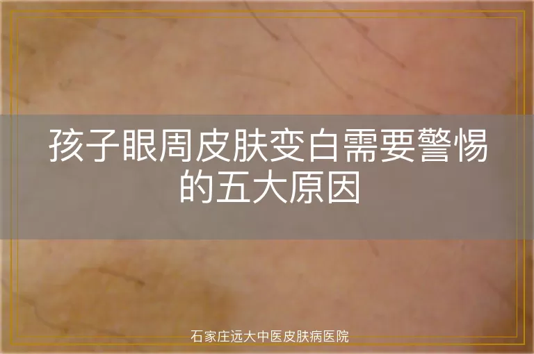 孩子眼周皮肤变白需要警惕的五大原因