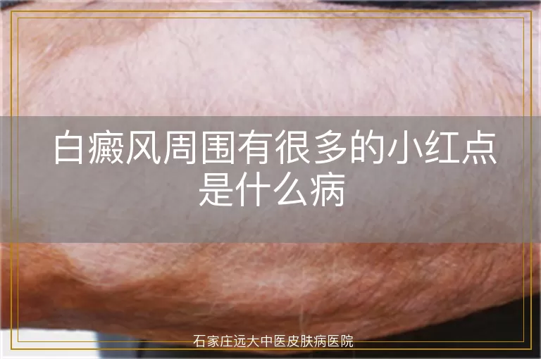白癜风周围有很多的小红点是什么病