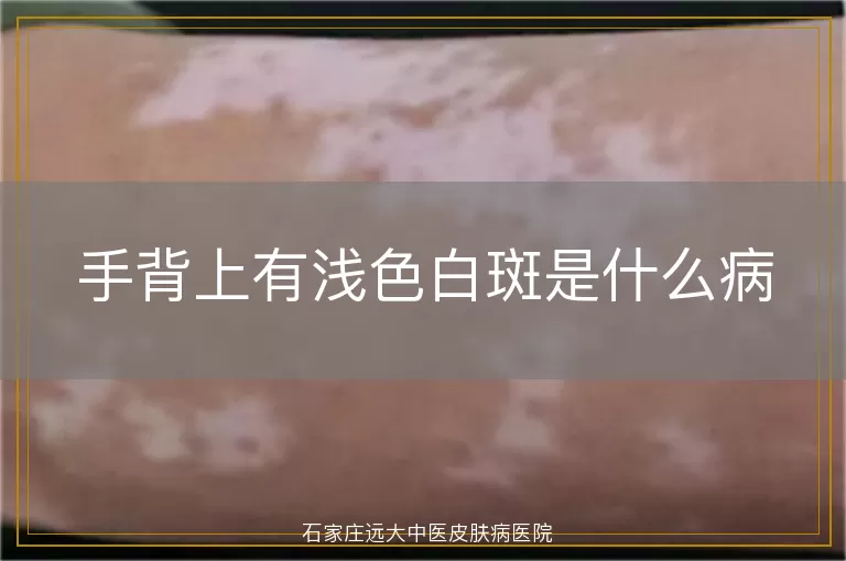 手背上有浅色白斑是什么病