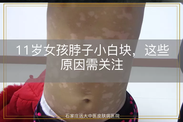 11岁女孩脖子小白块,这些原因需关注