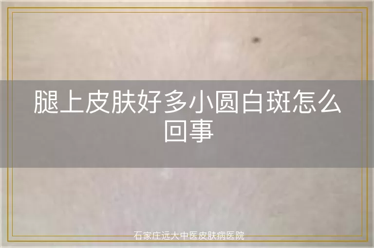 腿上皮肤好多小圆白斑怎么回事