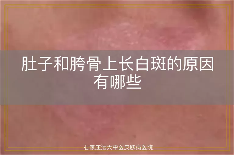 肚子和胯骨上长白斑的原因有哪些