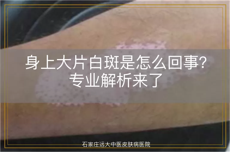 身上大片白斑是怎么回事？专业解析来了