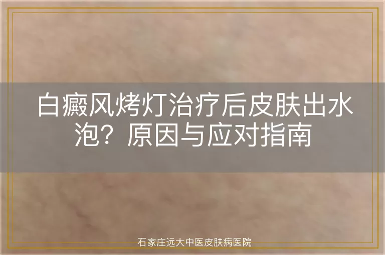 白癜风烤灯治疗后皮肤出水泡？原因与应对指南