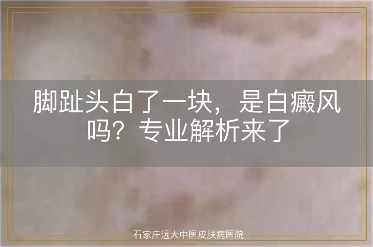 脚趾头白了一块，是白癜风吗？专业解析来了