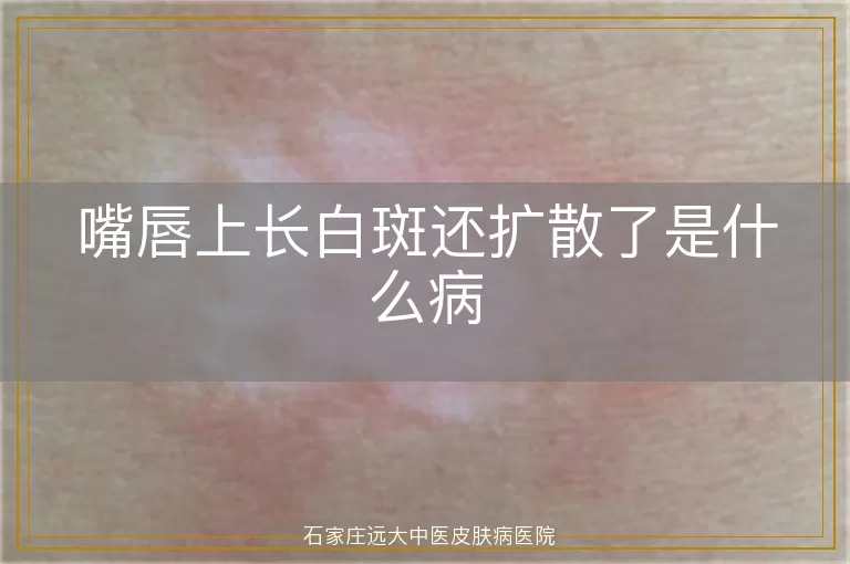 嘴唇上长白斑还扩散了是什么病