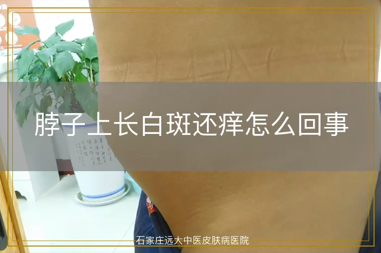 脖子上长白斑还痒怎么回事