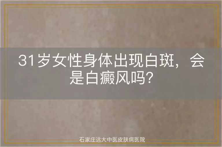 31岁女性身体出现白斑，会是白癜风吗？