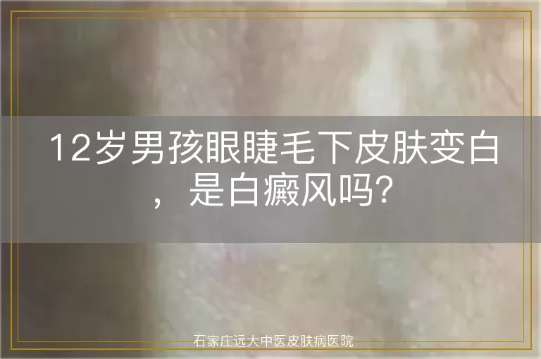 12岁男孩眼睫毛下皮肤变白，是白癜风吗？
