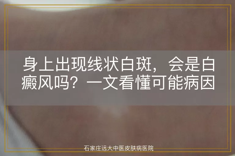 身上出现线状白斑，会是白癜风吗？一文看懂可能病因与应对