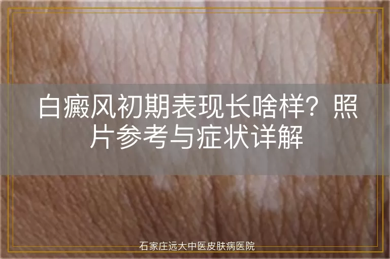 白癜风初期表现长啥样？照片参考与症状详解