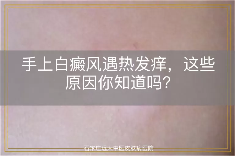 手上白癜风遇热发痒，这些原因你知道吗？