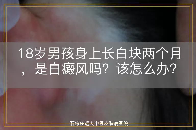 18岁男孩身上长白块两个月，是白癜风吗？该怎么办？