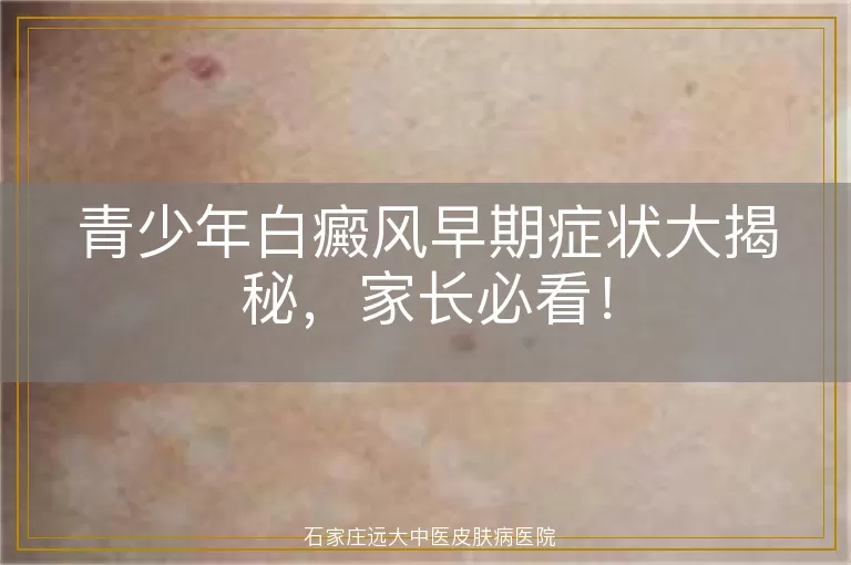 青少年白癜风早期症状大揭秘，家长必看！