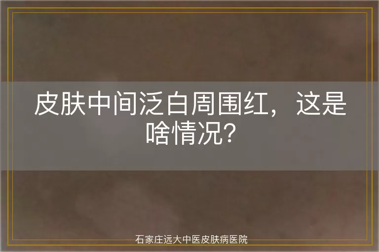 皮肤中间泛白周围红，这是啥情况？