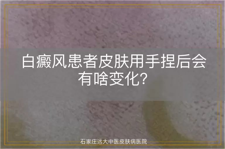 白癜风患者皮肤用手捏后会有啥变化？