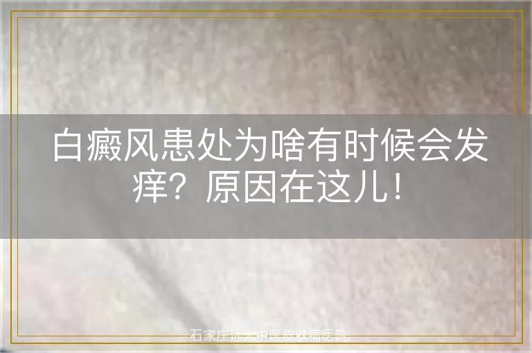 白癜风患处为啥有时候会发痒？原因在这儿！