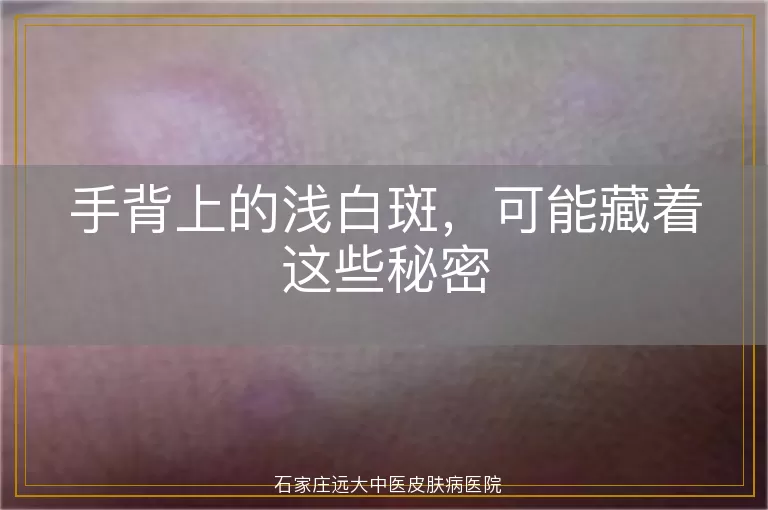 手背上的浅白斑，可能藏着这些秘密