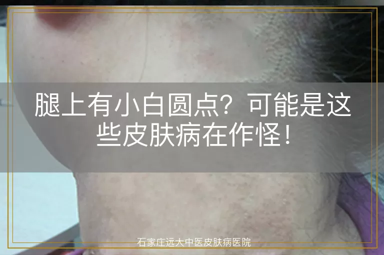 腿上有小白圆点？可能是这些皮肤病在作怪！