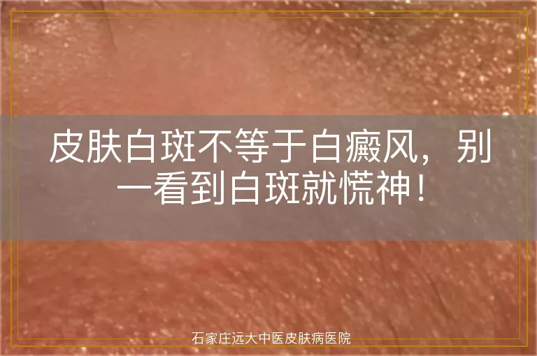 皮肤白斑不等于白癜风，别一看到白斑就慌神！