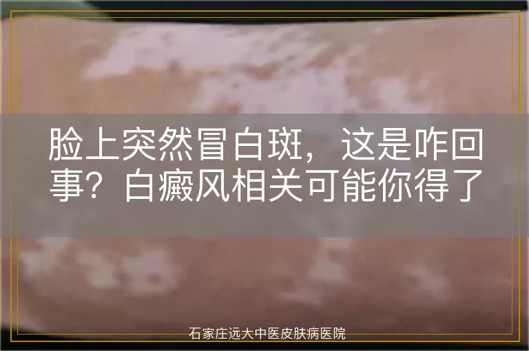 脸上突然冒白斑，这是咋回事？白癜风相关可能你得了解