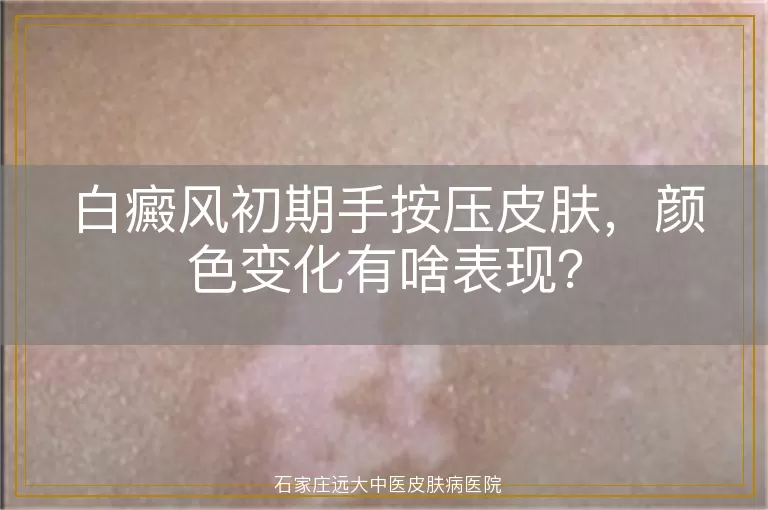白癜风初期手按压皮肤，颜色变化有啥表现？