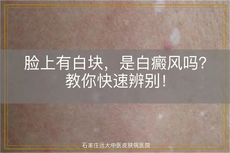 脸上有白块，是白癜风吗？教你快速辨别！