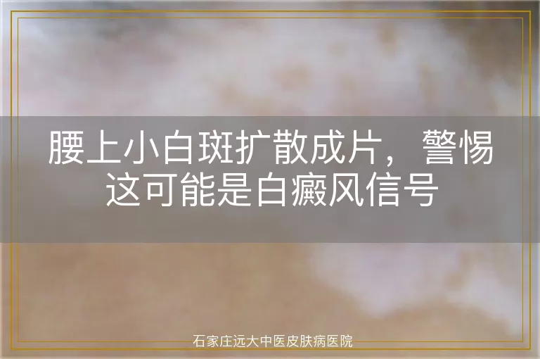 腰上小白斑扩散成片，警惕这可能是白癜风信号