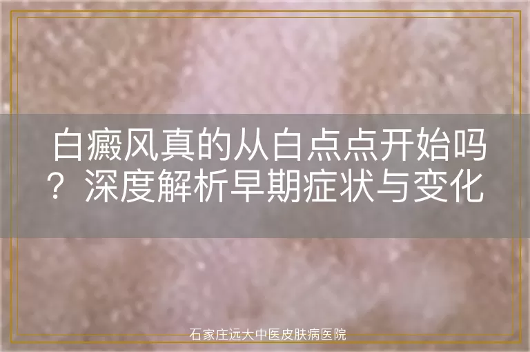 白癜风真的从白点点开始吗？深度解析早期症状与变化