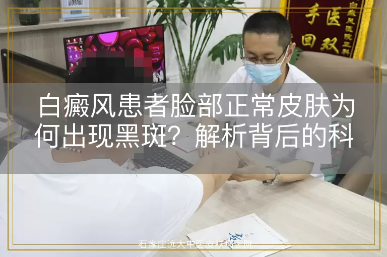 白癜风患者脸部正常皮肤为何出现黑斑？解析背后的科学原因