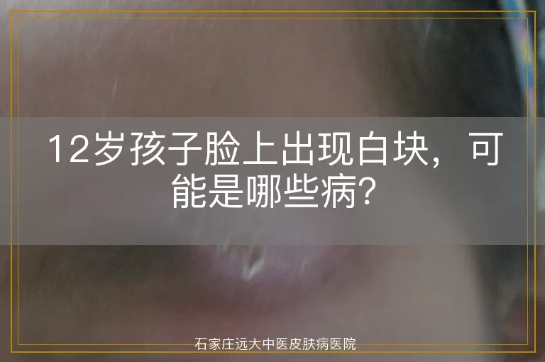 12岁孩子脸上出现白块，可能是哪些病？