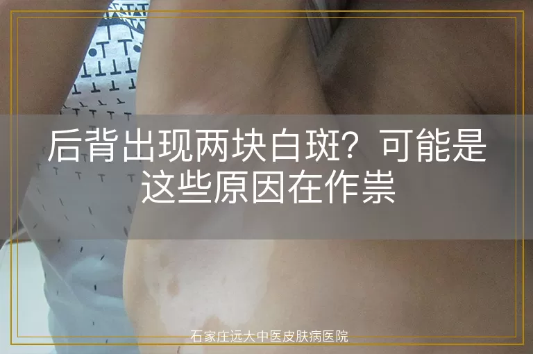 后背出现两块白斑？可能是这些原因在作祟