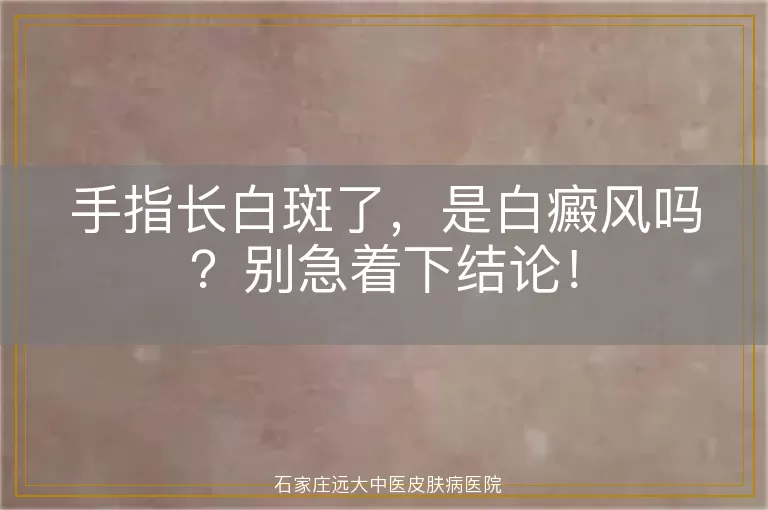 手指长白斑了，是白癜风吗？别急着下结论！